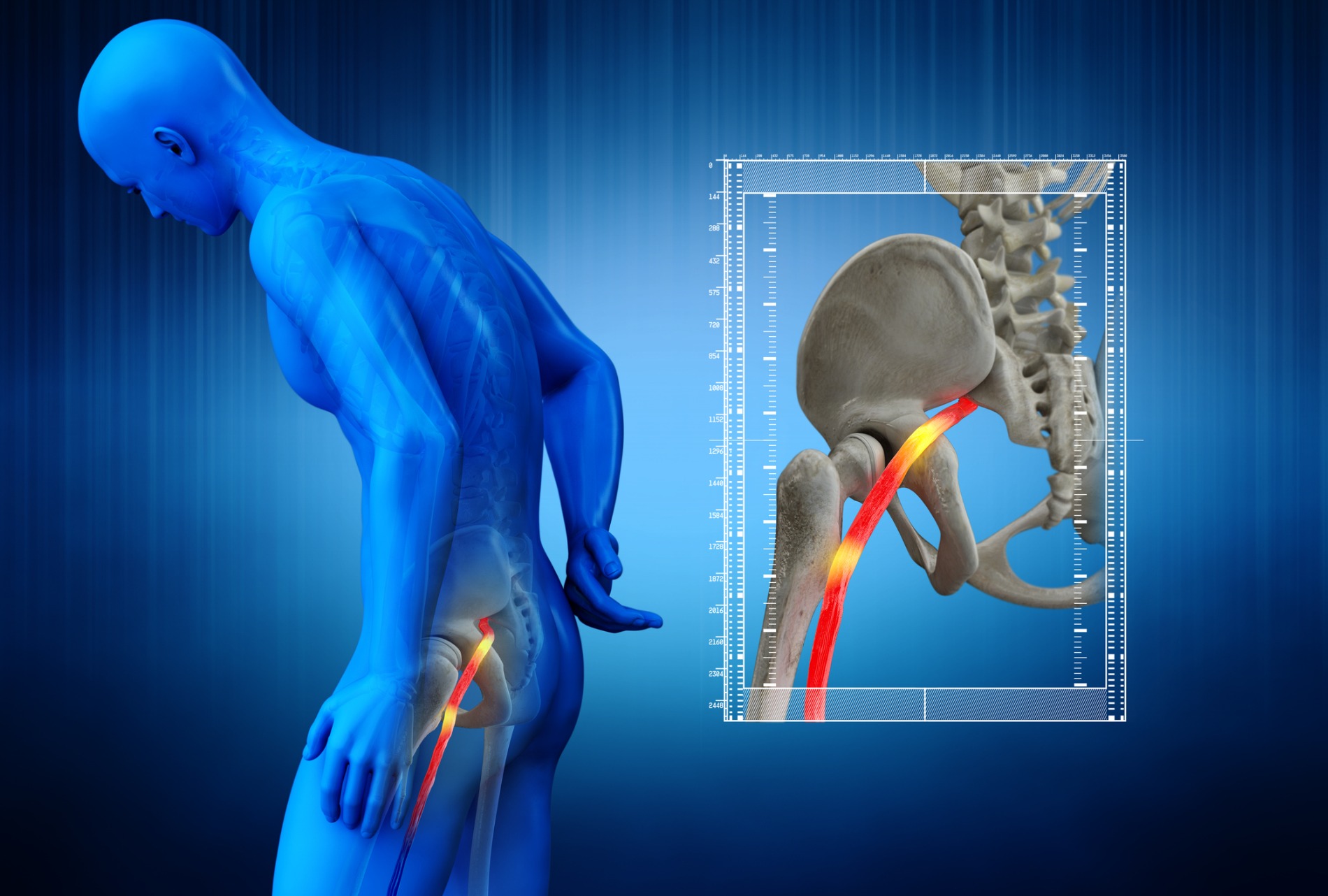 Causes Of Sciatica Nerve Pain