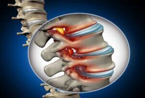 spine with spinal stenosis
